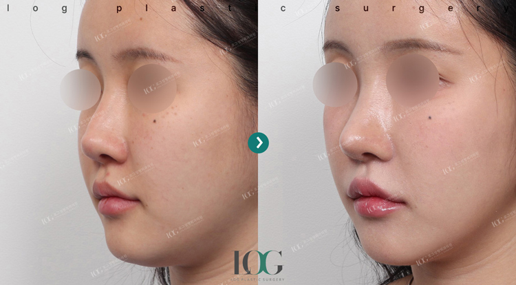 治療前・治療後