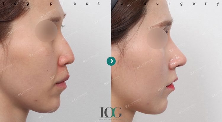 治療前・治療後