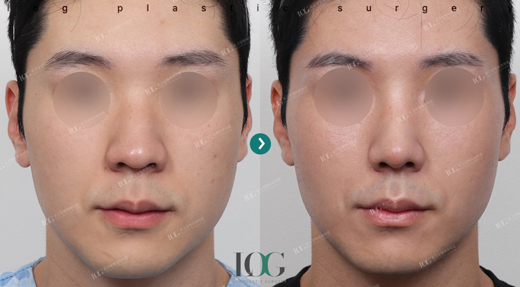 治療前・治療後